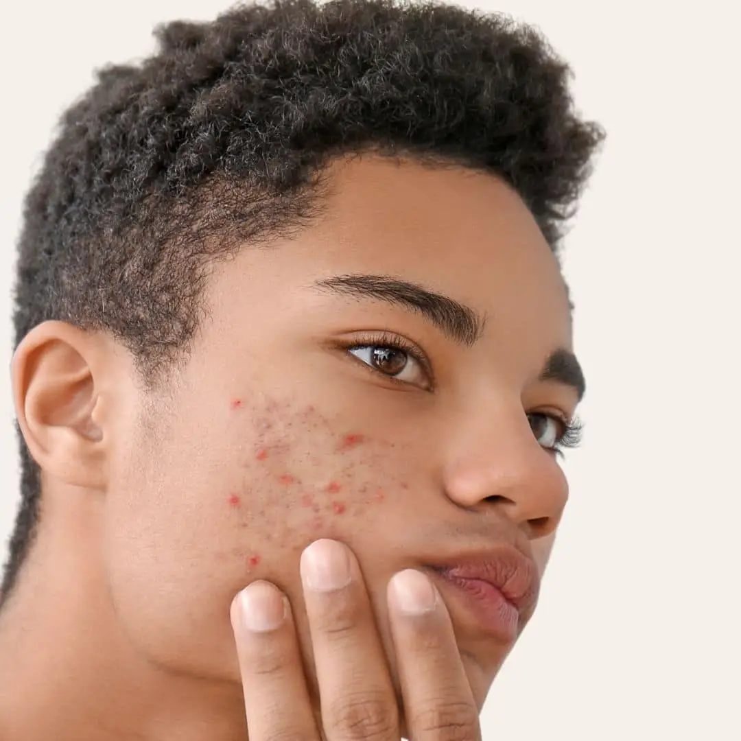 Acne Behandeling in Antwerpen