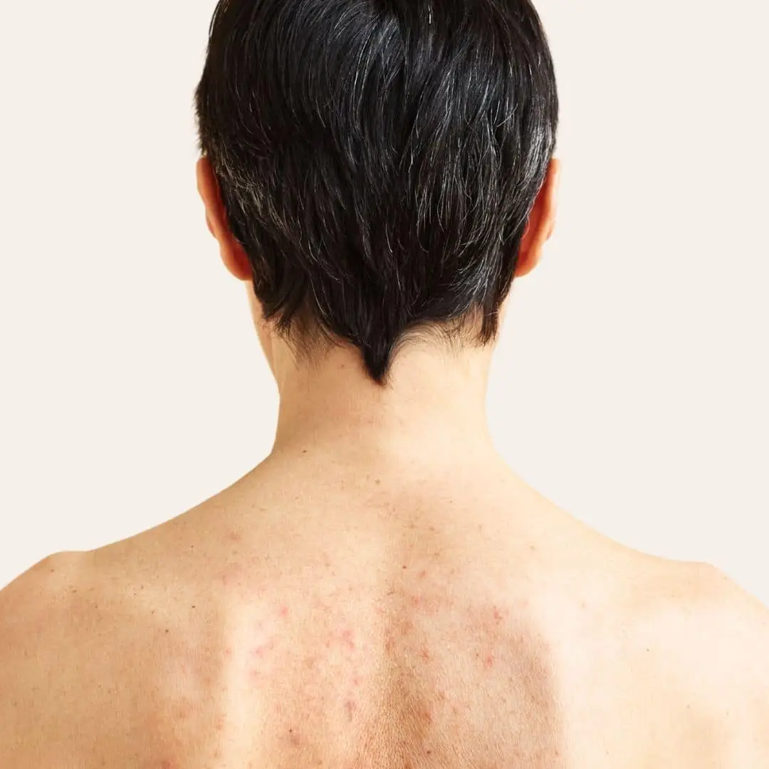 Behandeling Acne op Rug in Antwerpen