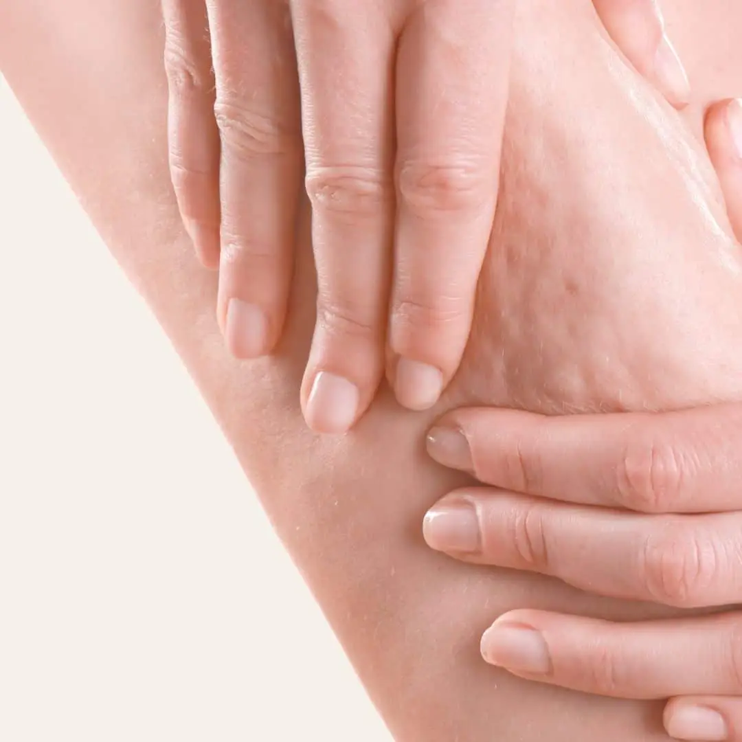 Cellulitis Behandeling in Antwerpen