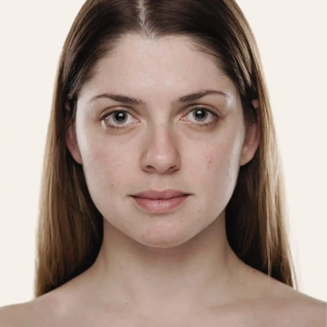 Doffe Huid behandelen in Antwerpen