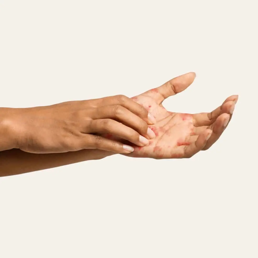 Eczeem Behandelen in Antwerpen