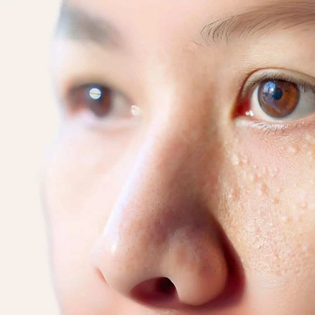 Gerstekorreltjes Verwijderen in Antwerpen