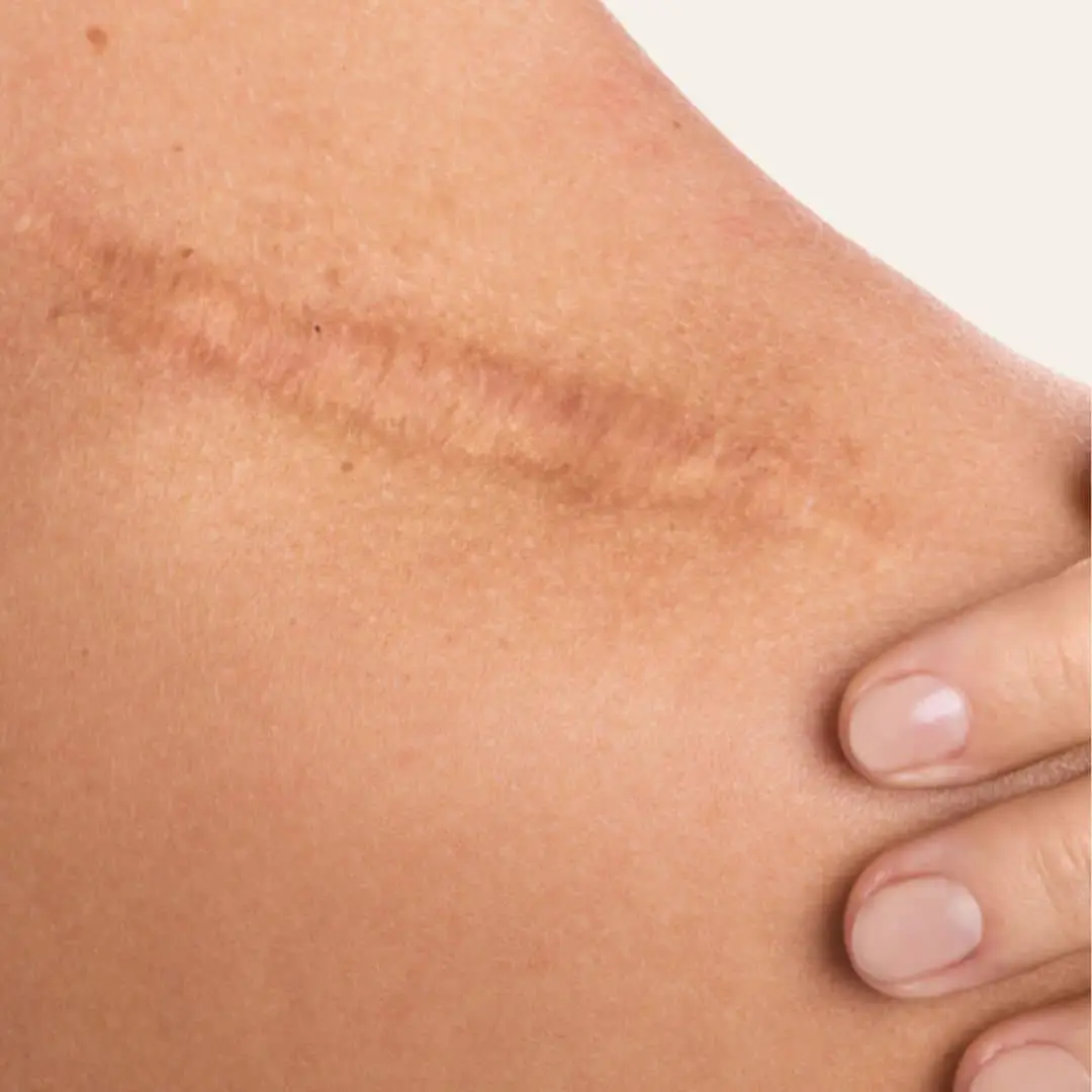 Littekens Verwijderen in Antwerpen