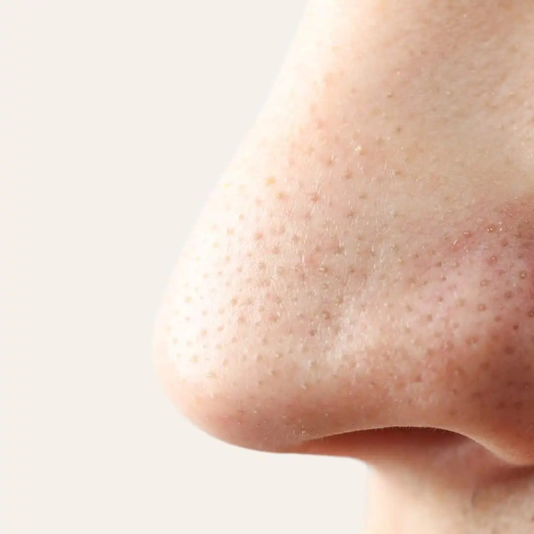 Mee-eters Verwijderen in Antwerpen