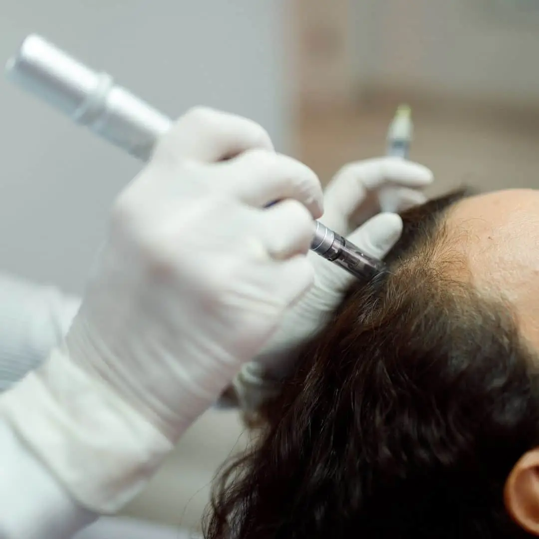 Effectieve Haarverlies Behandelingen In Antwerpen Mesotherapie Haar behandeling in Antwerpen