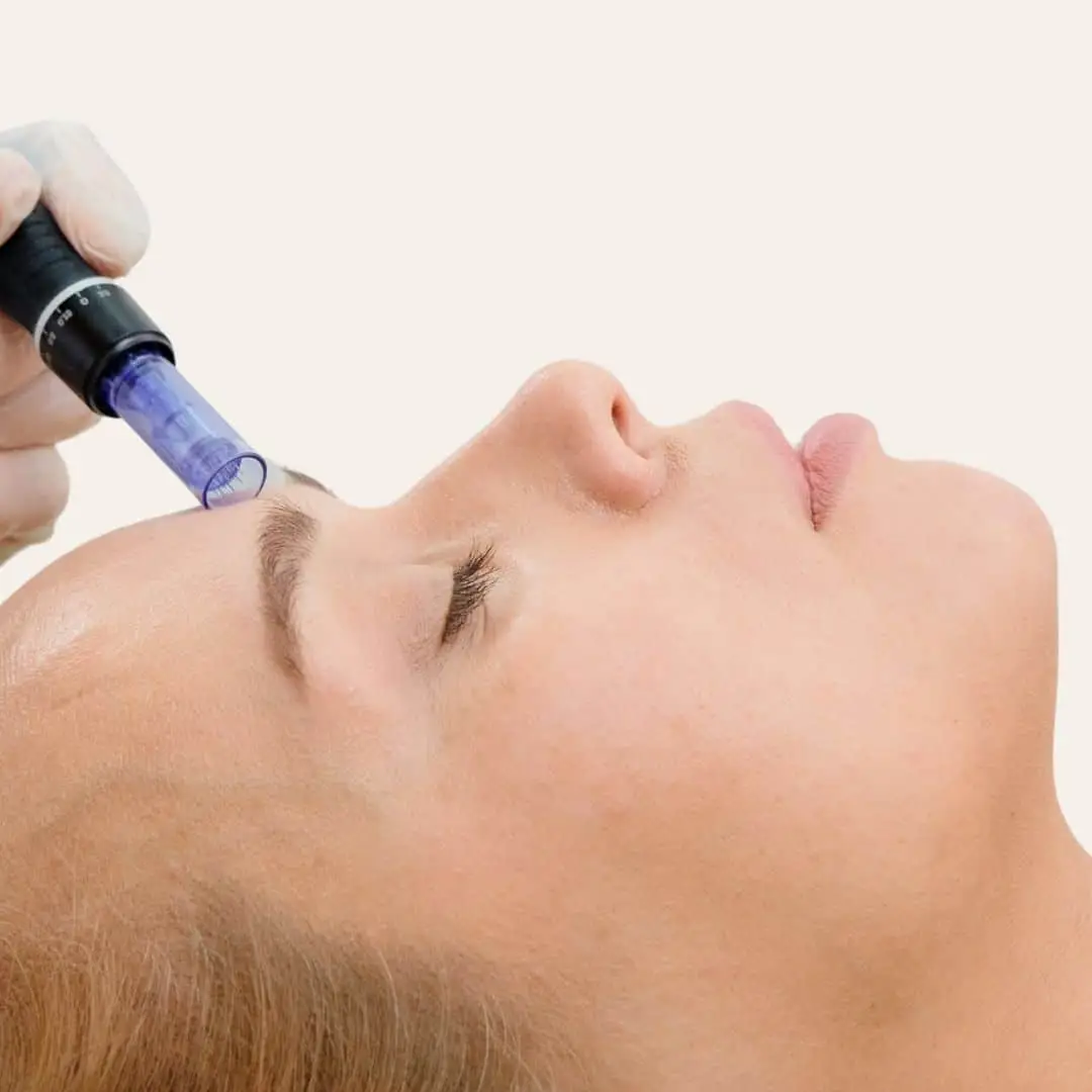 Microneedling Antwerpen
