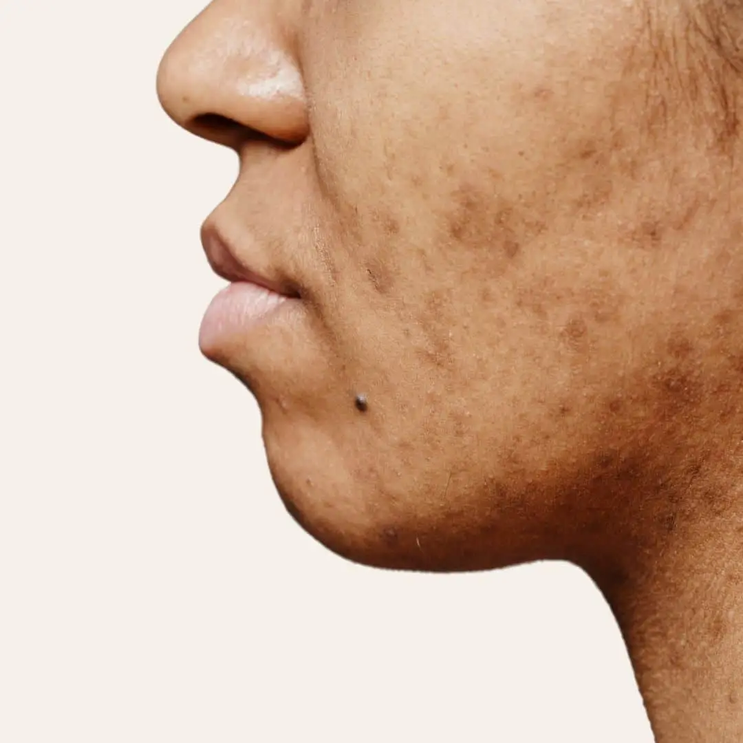 Pigmentvlekken Behandelen in Antwerpen