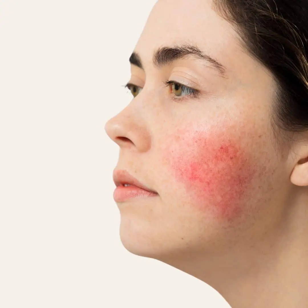 couperose behandeling in Antwerpen