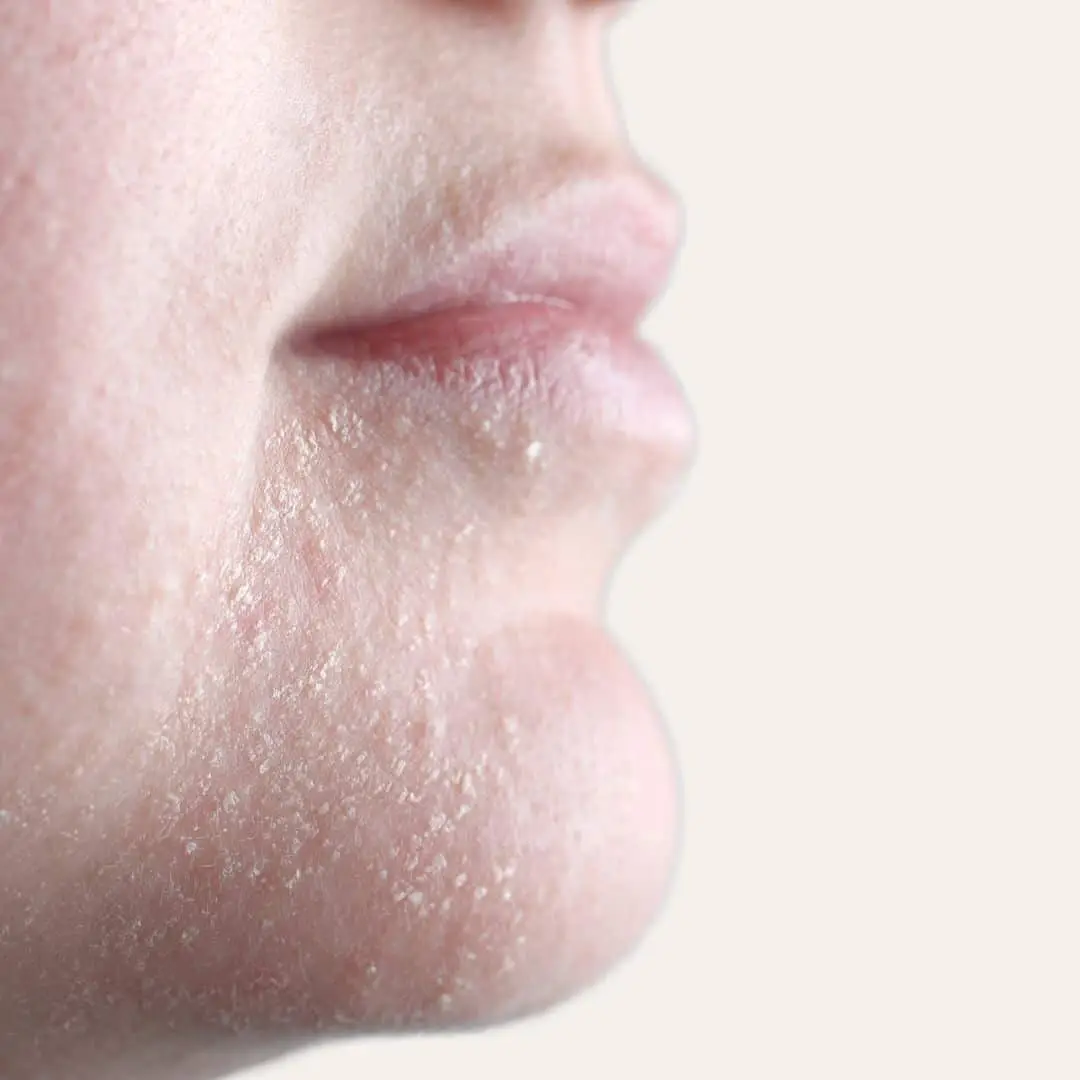 extreem droge huid behandeling in antwerpen