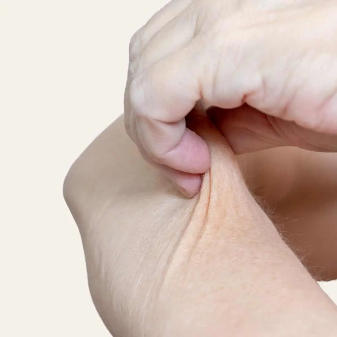 huidverslapping behandeling in Antwerpen