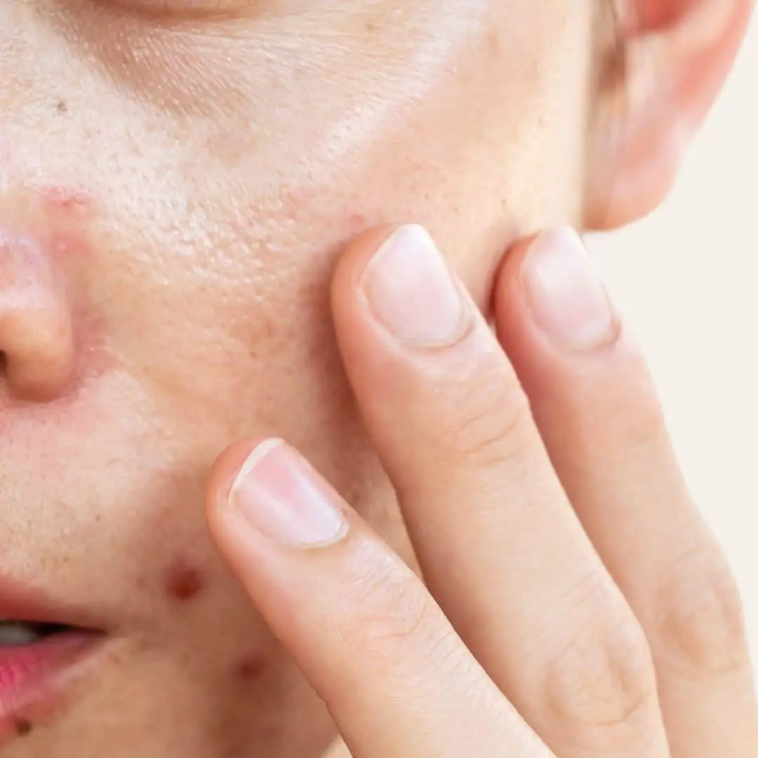 vette huid behandeling in Antwerpen